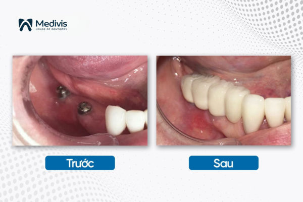 Trụ Implant Osstem 4