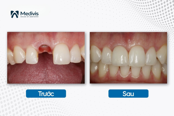 Trụ Implant Osstem 6